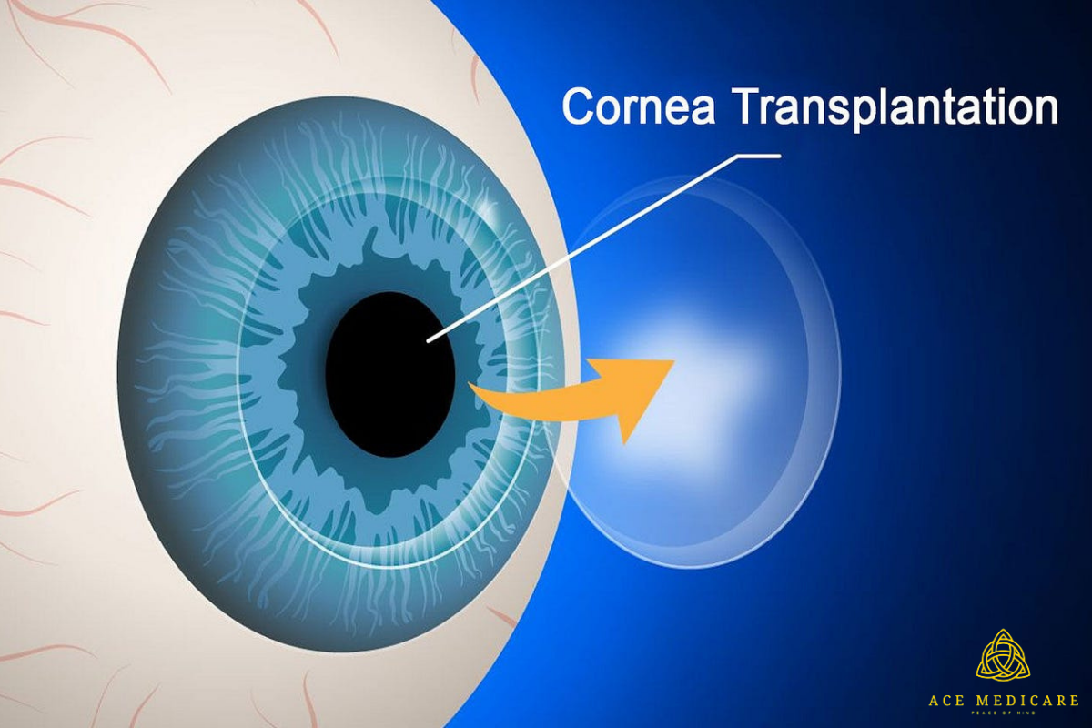 Cornea Transplants: A Glimpse into the Future of Vision Restoration